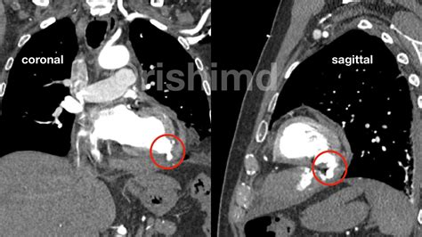 lv angio|left ventricular pseudoaneurysm vs aneurysm.